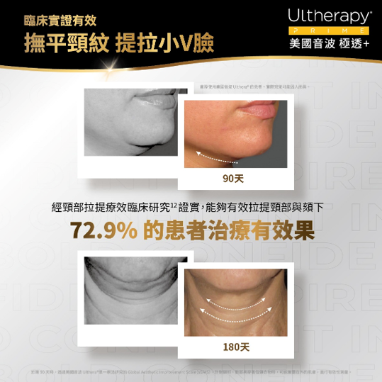 中下臉豐潤下垂型 , 下顎線條模糊、嘴角周圍鬆弛,常見於圓潤臉型。 這種情況適合運用 4.5mm 結合 3.0mm 探頭進行雙層施打。